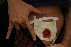 Nasty Staph Infection